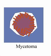 Image result for Mycetoma