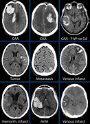 Image result for Orbital Hemorrhage CT