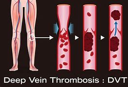 Image result for Thrombotic Veins