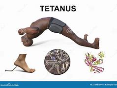 Image result for Tetanus Spasm