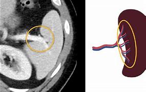 Image result for Spleen Enlargement CT