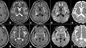 Image result for Hepatic Encephalopathy MRI