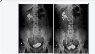 Image result for J-shaped Ureter