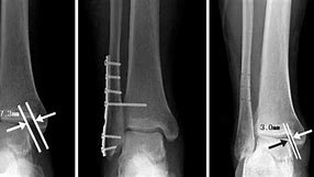 Image result for Lateral Malleolus Fracture Splint