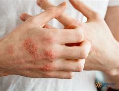 Image result for Scaly Rash