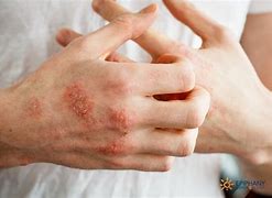 Image result for Rash Diagnosis