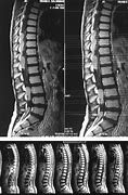 Image result for Neuropil Medulloblastoma