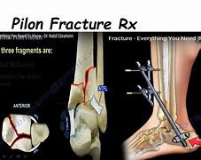 Image result for Open Pilon Fracture