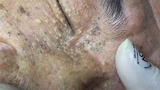 Image result for Pimple Popping