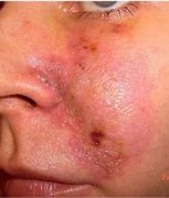 Image result for Pustules On Nose