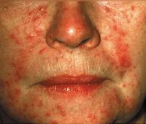 Image result for Face Mites Treatment