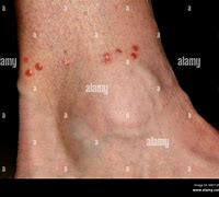 Image result for Bed Bug Bites Row