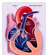 Image result for Right Ventricular Outflow Tract