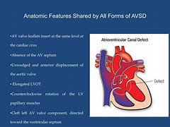 Image result for AV Canal Defect Down Syndrome