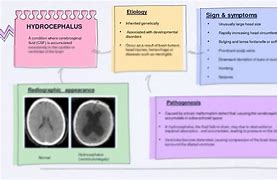 Image result for Hydrocephalus Concept Map