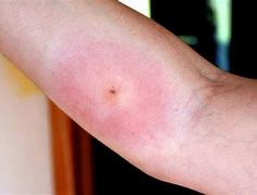 Image result for Blood with Circle Bite