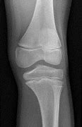 Image result for PA Oblique Lateral Rotation Knee