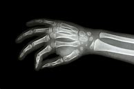 Image result for X-ray of Baby Hand