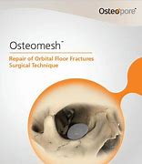 Image result for Orbital Floor Reconstruction