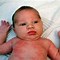 Image result for Eczema On Baby Arm