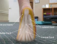 Image result for Medial Plantar Fascia