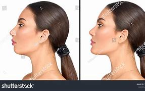 Image result for Rescesed Chin