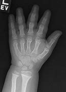 Image result for Trident Hand Achondroplasia