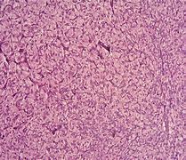 Image result for Pheochromocytoma Renin