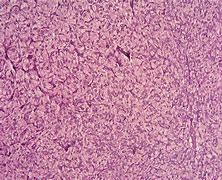 Image result for Light Bulb Sign Pheochromocytoma