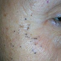 Image result for Black Spots On Skin Means