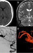 Image result for Aneurysm in MRI