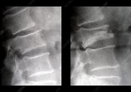 Image result for Lumbar Compression Burst Fractures