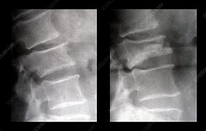 Image result for Imagees Compression Fracture of Lumbar Vertebrae