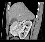 Image result for Adrenal Gland Adenoma