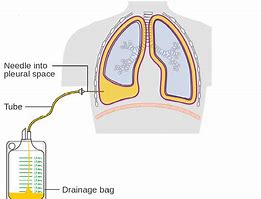 Image result for Pleural Effusion Images