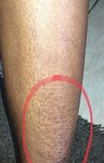 Image result for Skin Darkening Legs