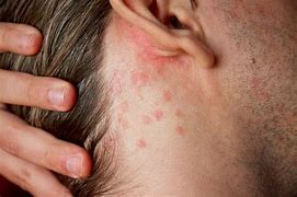 Image result for Psoriasis Bumps On Skin