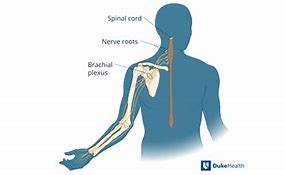 Image result for Brachial Plexus Injury