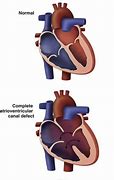 Image result for Complete Atrioventricular Canal Defect