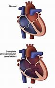 Image result for Atrioventricular Canal Defect Osmosis