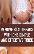 Image result for Remove Blackheads