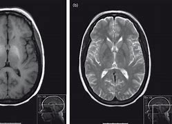 Image result for Hepatic Encephalopathy MRI