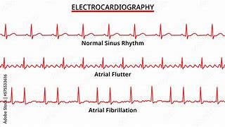 Image result for Ventricular Flutter and Fibrillation