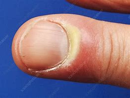 Image result for Ingrown Nail