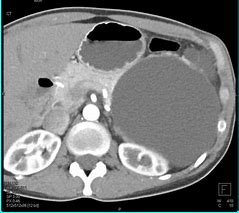 Image result for Cyst On Spleen