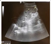 Image result for Spleen Metastasis