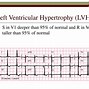 Image result for RVH ECG