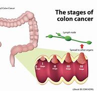 Image result for Cancer De Colon Tac