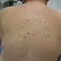 Image result for Benign Skin Bumps