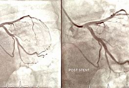 Image result for Coronary Artery Angiography